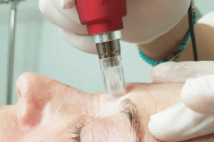 Dermapen con cóctel vitamínico: microestimulación para una piel más joven y saludable