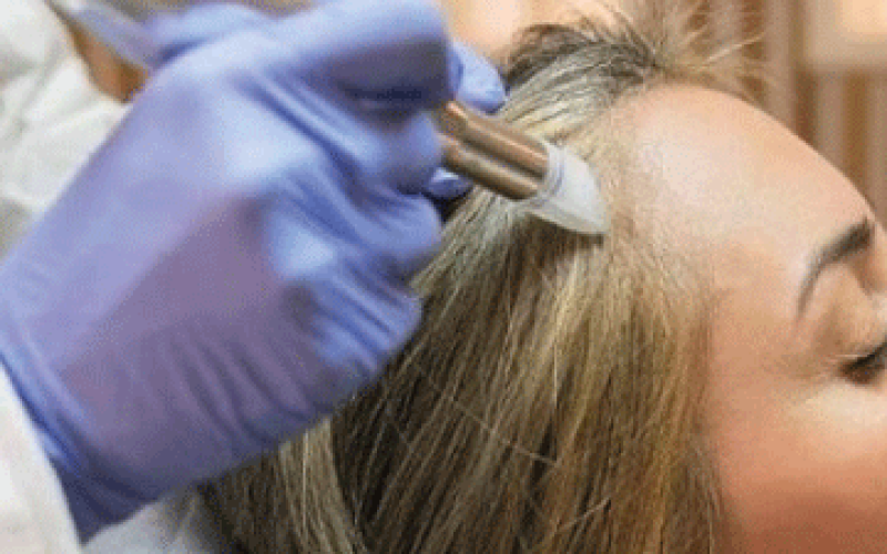 Dermapen capilar: qué es y cómo ayuda a frenar la caída del cabello